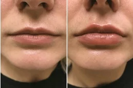 Results OF Lip Augmentation