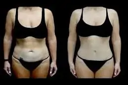 Results OF Lipo Abdominoplasty Cost Dubai