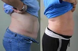 Results OF Lipo Abdominoplasty Cost in Dubai