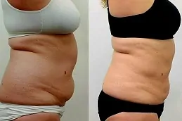 Results OF Lipo Abdominoplasty clinic Dubai