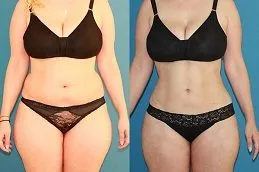 Results OF Mini Abdominoplasty Clinic in Dubai
