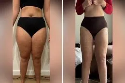 Results OF Mini Abdominoplasty Treatment in Dubai
