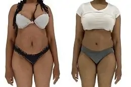 Results OF Mini Abdominoplasty clinic in Dubai