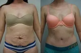 Results OF Mini Abdominoplasty clinic in Dubai,