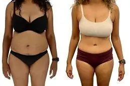 Results OF Mini Abdominoplasty in Dubai