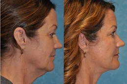 Results OF Neck Lift Dubai