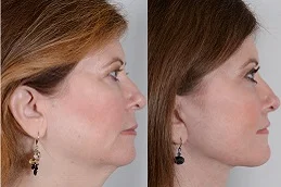 Results OF Neck Lift clinic Dubai
