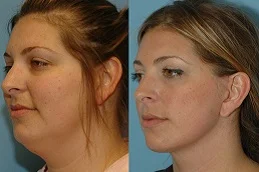 Results OF Neck Lift clinic in Dubai