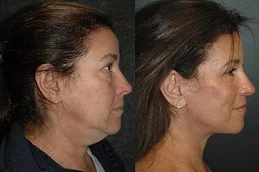 Results OF Neck Lift clinic in Dubai,