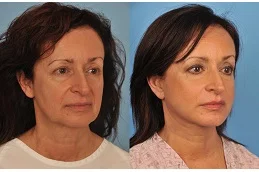 Results OF Neck Lift in Dubai