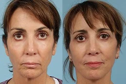 Results OF Neck Lift in Dubai,