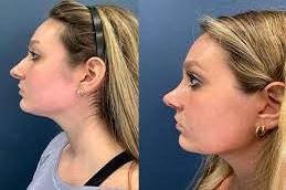 Results OF Rhinoplasty Surgery Dubai