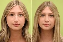 Results OF Rhinoplasty Surgery Dubai