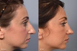 Results OF Rhinoplasty Surgery clinic in Dubai