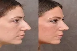Results OF Rhinoplasty Surgery in Dubai