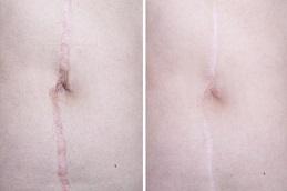 Results OF Surgical Scar Revision Dubai