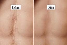 Results OF Surgical Scar Revision clinic Dubai