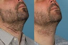 Results OF Surgical Scar Revision