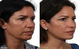 Results OF Thread Lift Dubai & Abu Dhabi