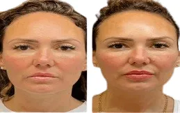 Results OF Thread Lift clinic in Dubai & Abu Dhabi