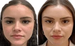 Results OF Thread Lift clinic in Dubai