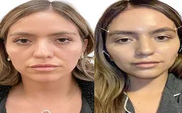 Results OF Thread Lift in Dubai & Abu Dhabi