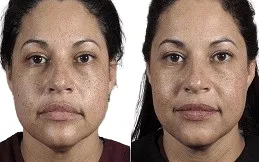 Results OF Thread Lift in Dubai