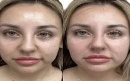 Results OF Thread Lift teatment in Dubai