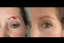 Surgical Scar Revision Before & After clinic Dubai