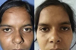 Surgical Scar Revision Before & After clinic in Dubai