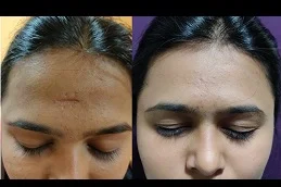Surgical Scar Revision Before & After in Dubai