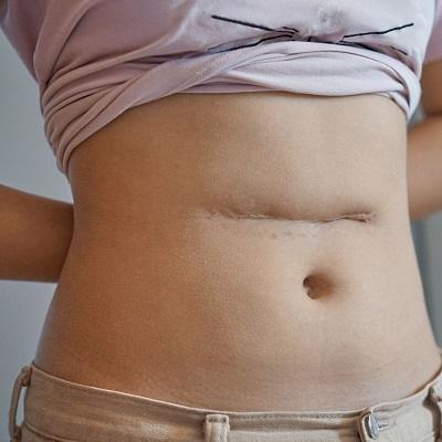 Surgical Scar Revision in Dubai & Abu Dhabi