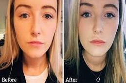 The Science Behind Effective Lip Filler Treatments clinic Dubai