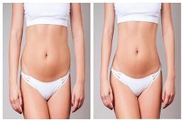 Waist Sculpting Before & After Dubai,