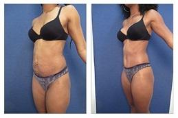 Waist Sculpting Before & After clinic Dubai,