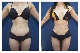 Waist Sculpting Before & After,