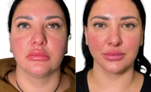 Endolift Surgery Before & After