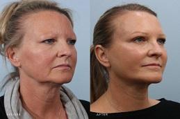 Endolift Surgery Before & After Dubai & Abu Dhabi,