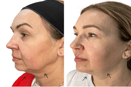 Endolift Surgery Before & After Dubai