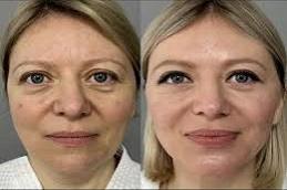 Endolift Surgery Before & After clinic Dubai & Abu Dhabi