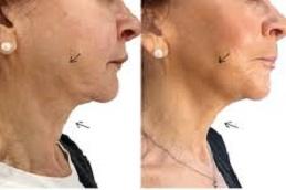 Endolift Surgery Before After clinic Dubai