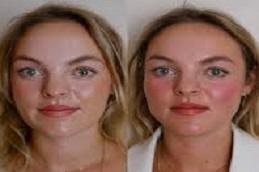 Endolift Surgery Before & After in Dubai & Abu Dhabi