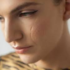 Facial Scar Revision Cost in Dubai & Abu Dhabi