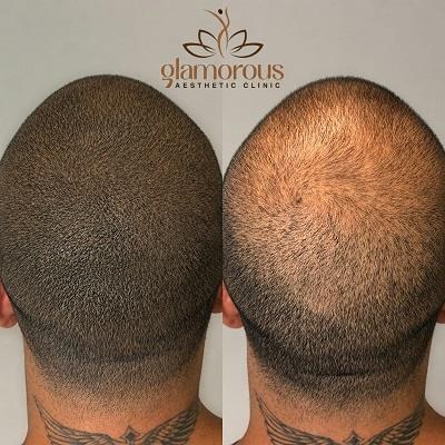 Hair Transplant Cost in Dubai & Abu Dhabi