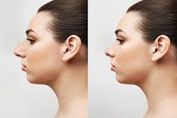 Nose Tip Plasty Before & After