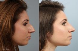 Nose Tip Plasty Before & After clinic in Dubai,
