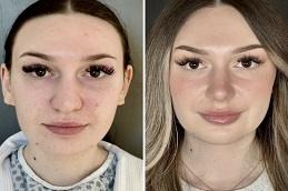 Nose Tip Plasty Before & After clinic