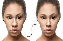 Nose Tip Plasty Before & After,