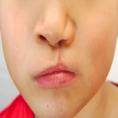 Palate Repair Surgery Cost in Dubai & Abu Dhabi