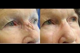 Results OF Facial Scar Revision Clinic in Dubai,